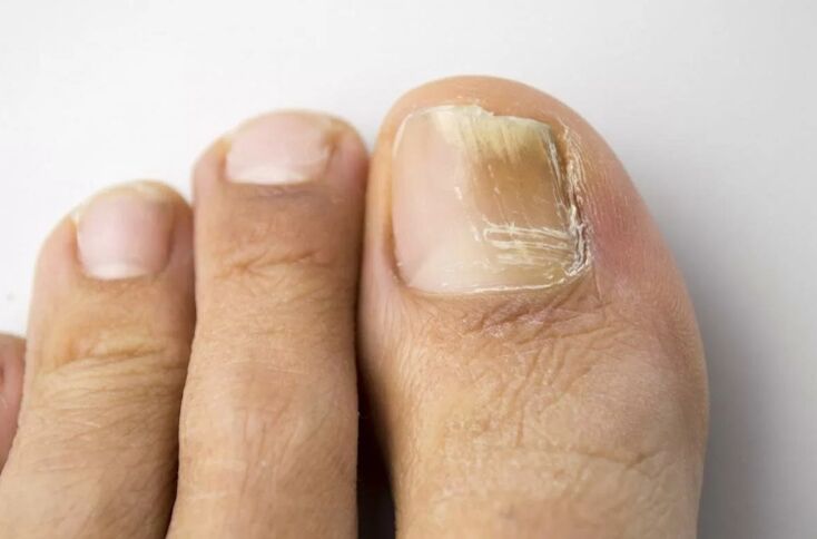 Beinnagel Mykose