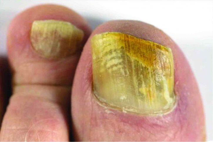 Gefühl des Nagels im Bein